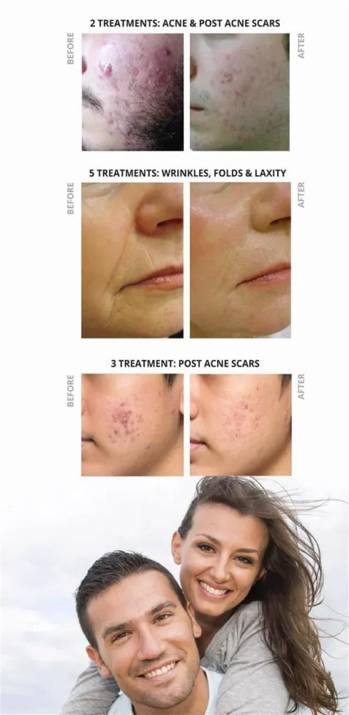 Acne Treatment Results with Viora Laser!