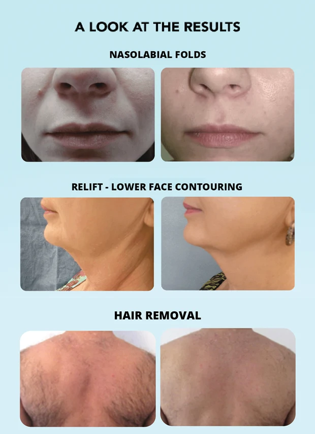Skin Tightening With Viora Laser!